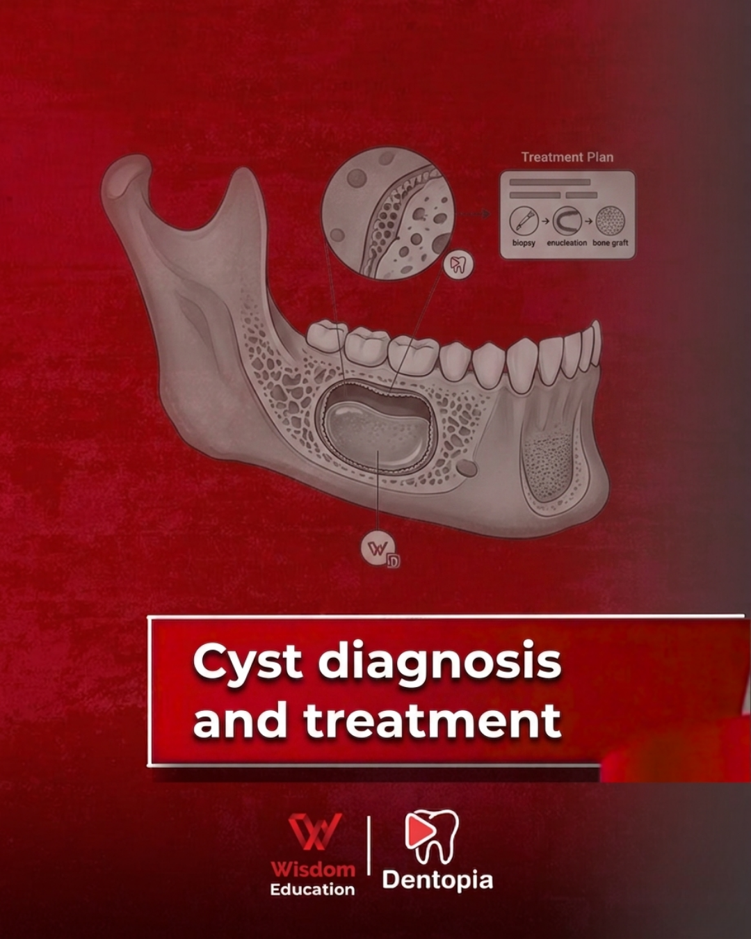 Cysts diagnosis and treatment