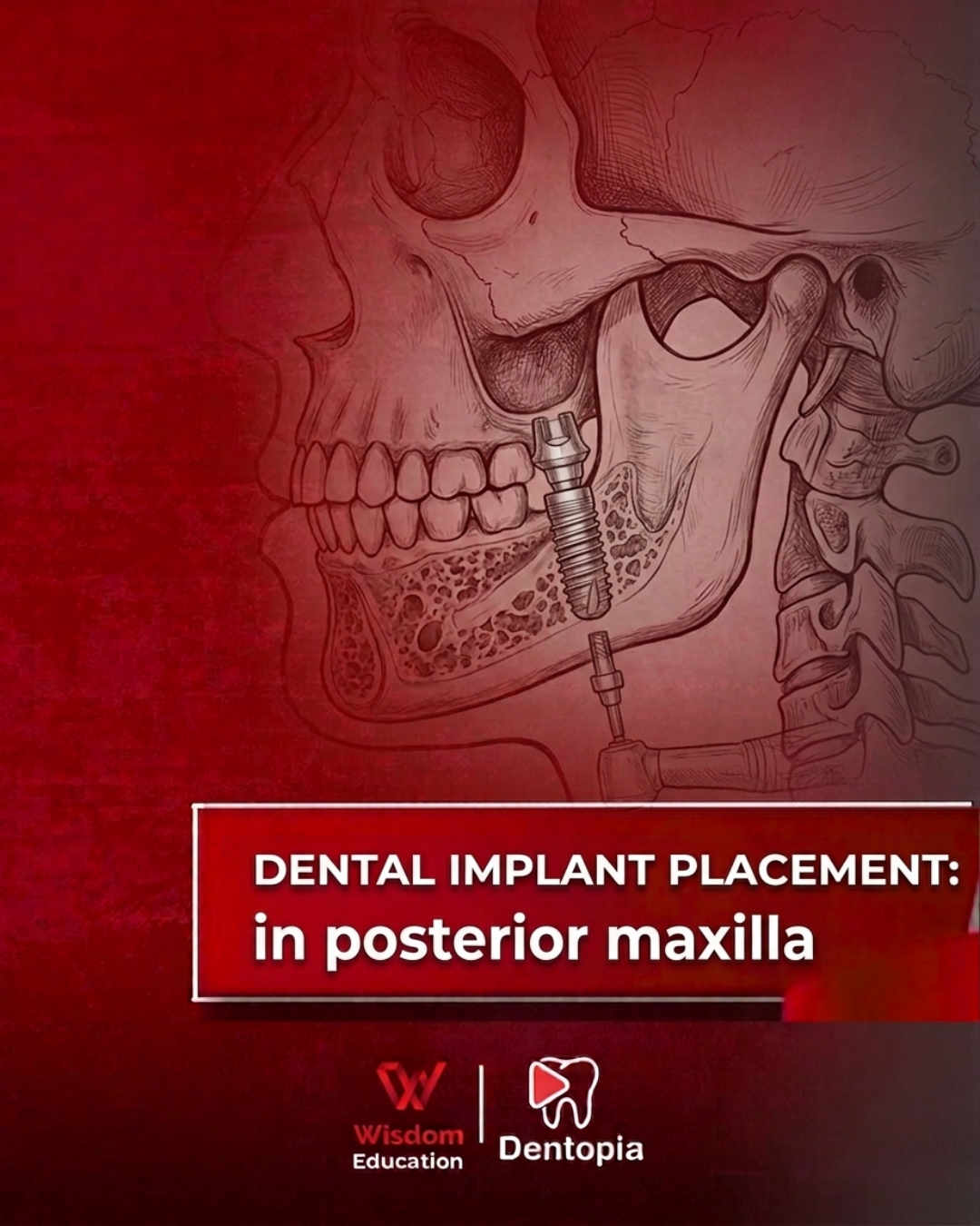 Implantology Hands-on Course