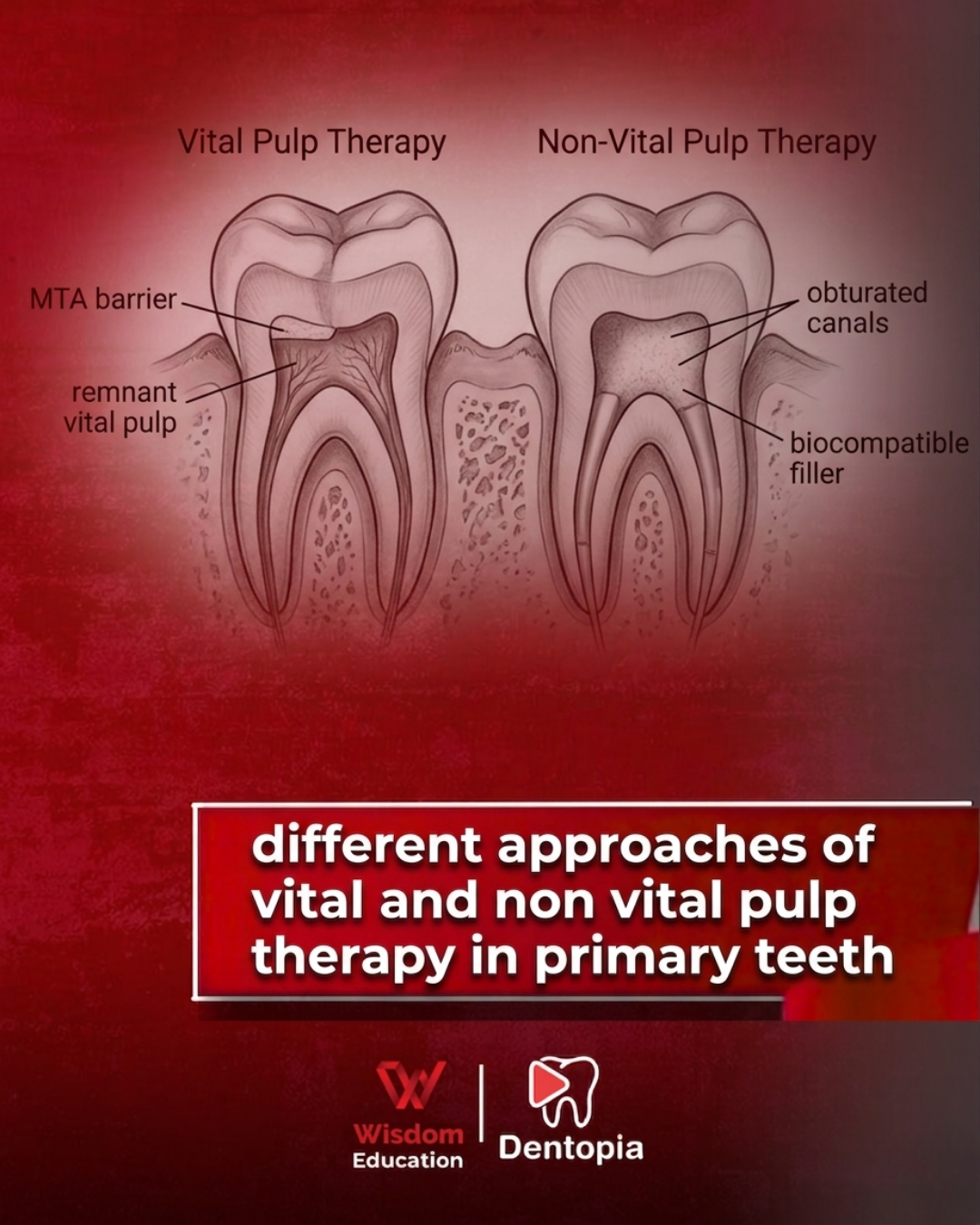 different approaches of vital and non vital pulp therapy in primary teeth