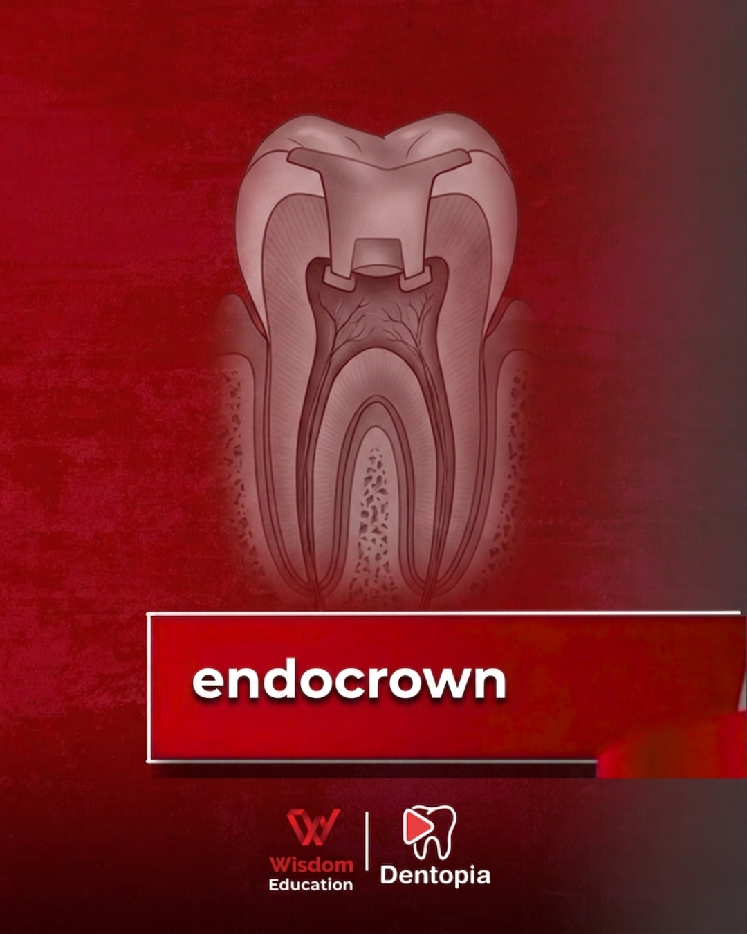 endocrown