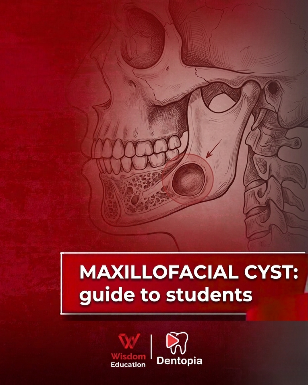 MAXILLOFACIAL CYST :guide to students
