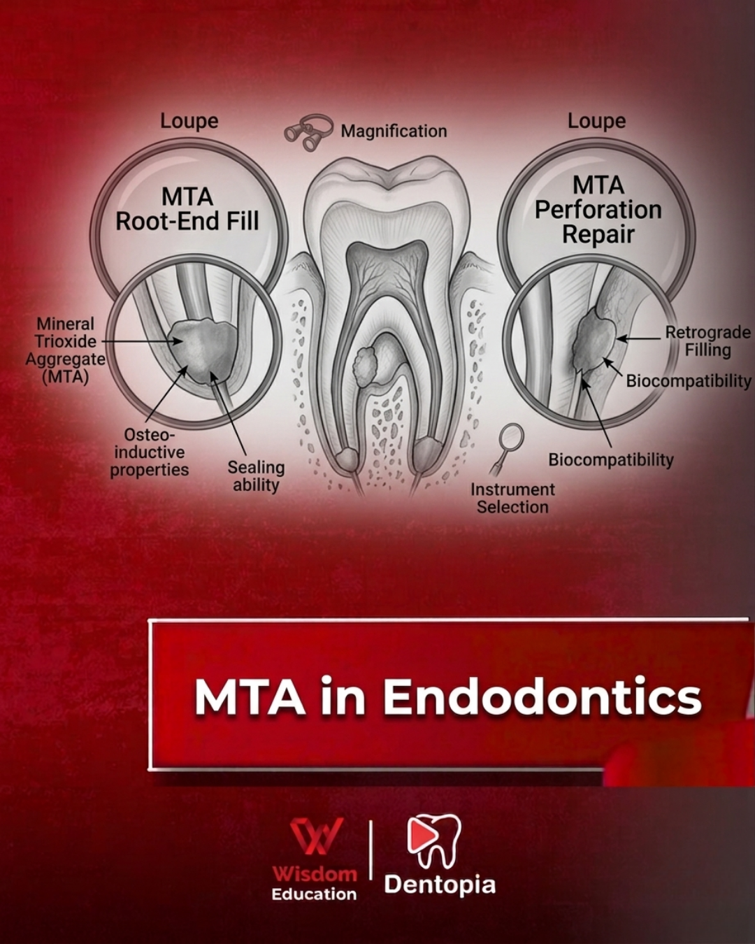 MTA in Endodontics