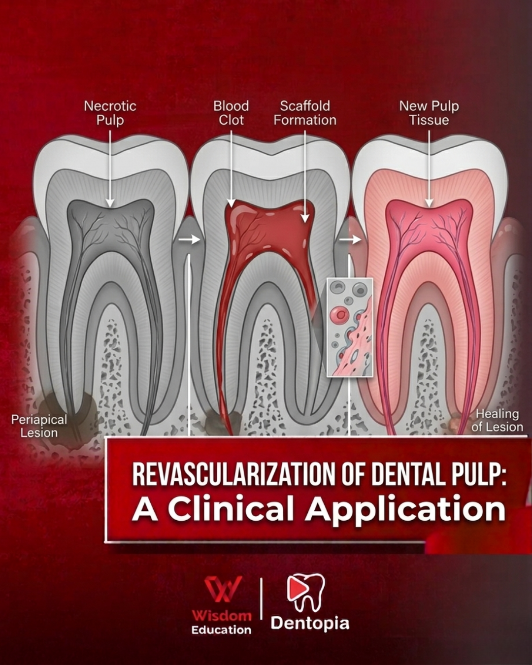 Revascuralization of Dental pulp. A climical Application