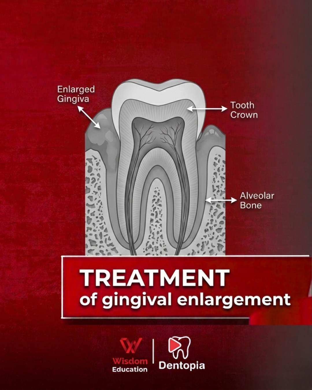 TREATMENT of gingival enlargement